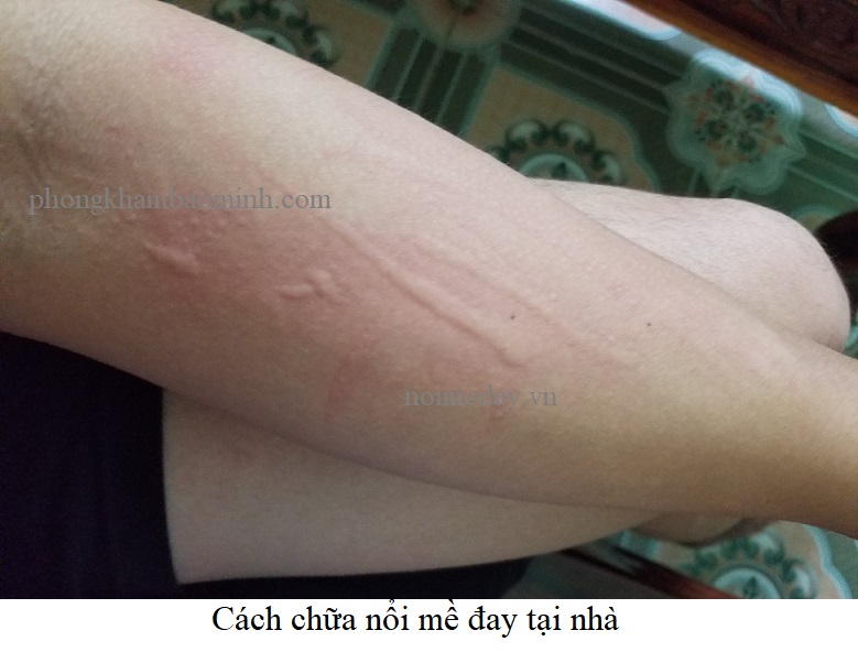 Cách chữa nổi mề đay 